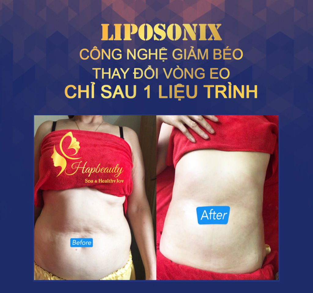 Hiệu quả giảm béo công nghệ Liposonix.